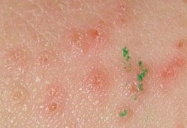 Por que ungüentos curan la psoriasis
